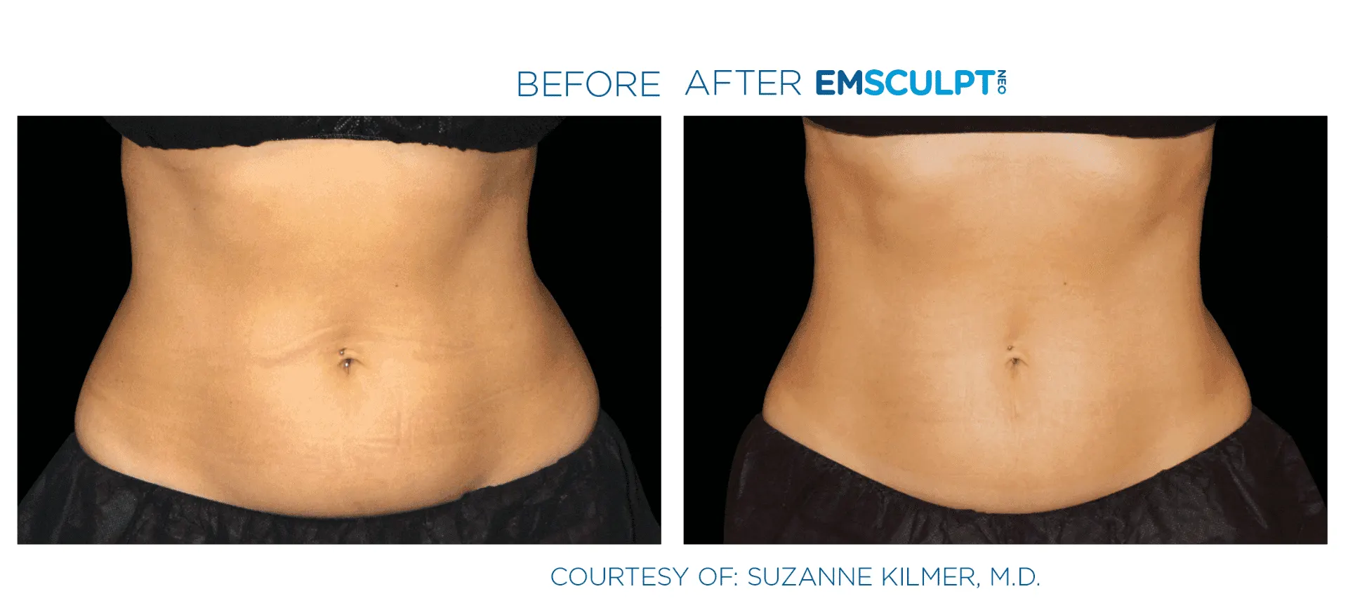 Emsculpt Neo - Before and After