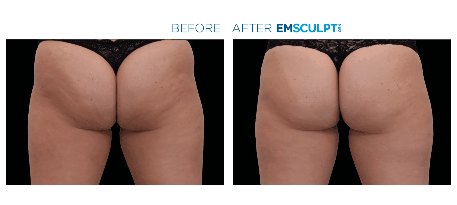 Emsculpt Neo - Before and After