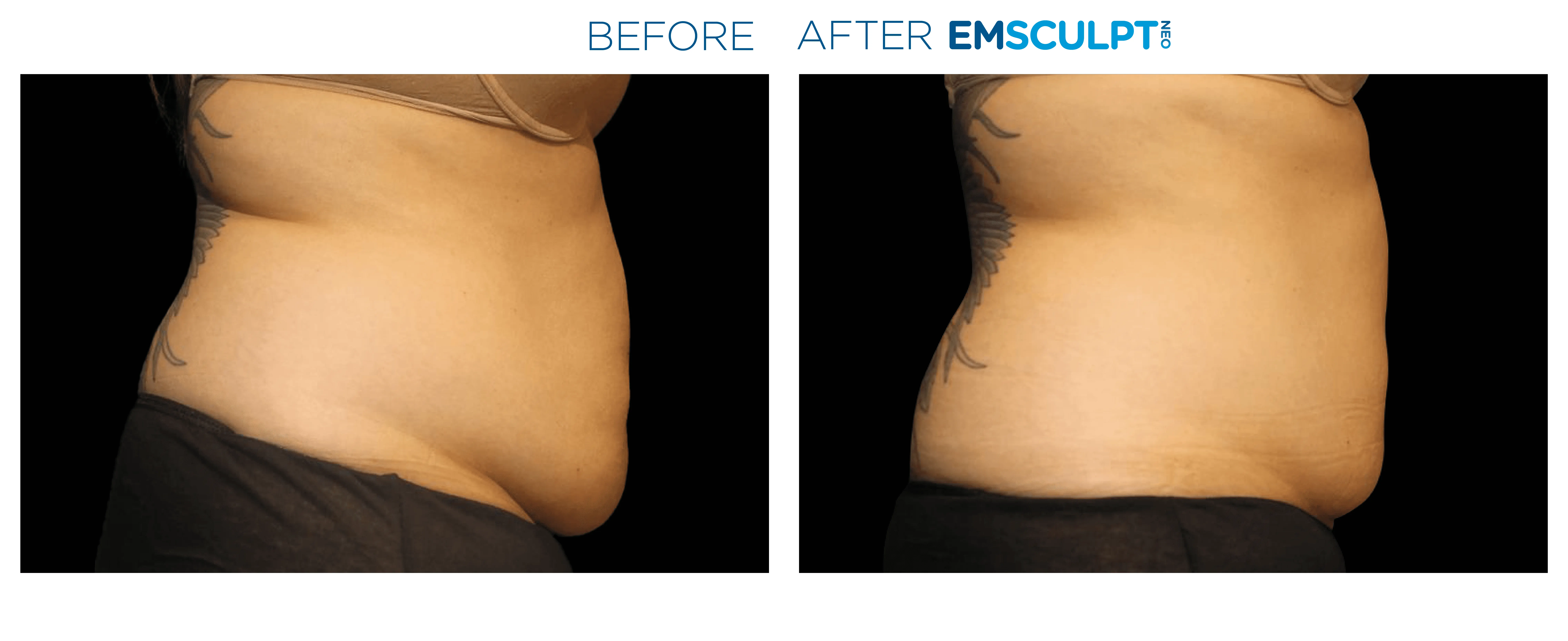 Emsculpt Neo - Before and After