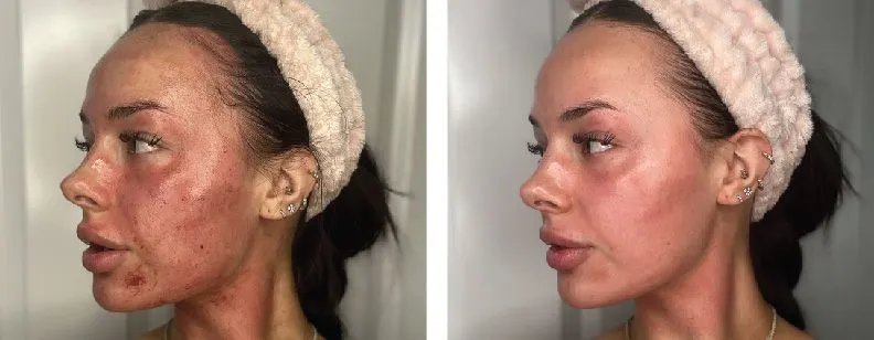 RF Microneedling with Exosomes - Before and After