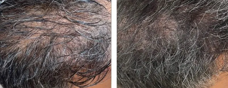 RF Microneedling with Exosomes - Before and After