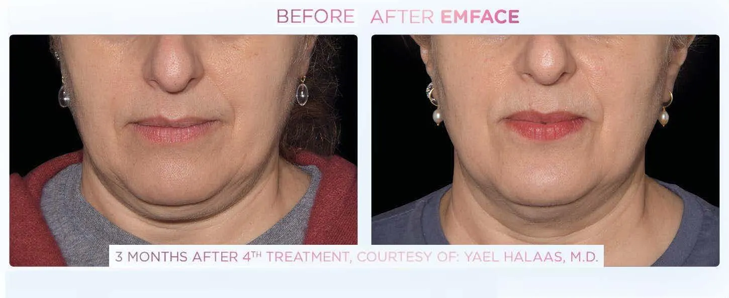 Emface - Before and After