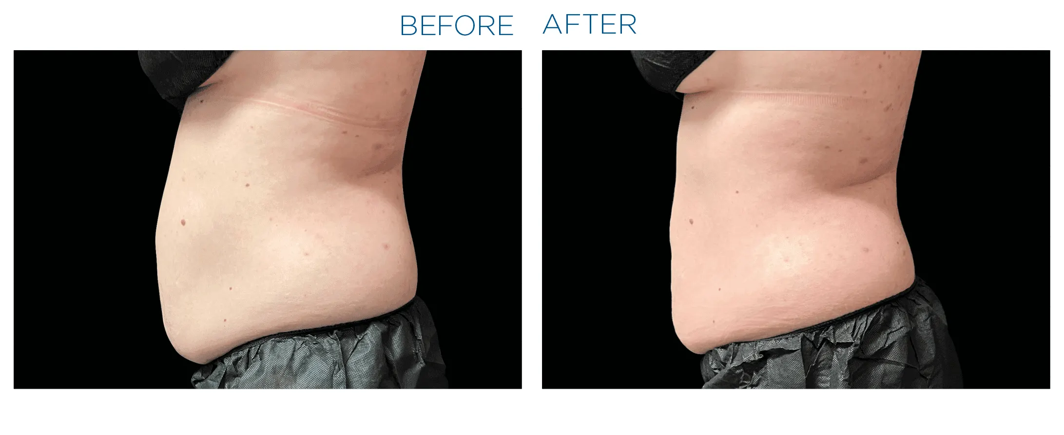 Emsculpt Neo - Before and After