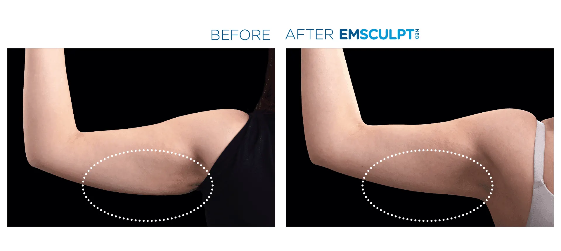 Emsculpt Neo - Before and After