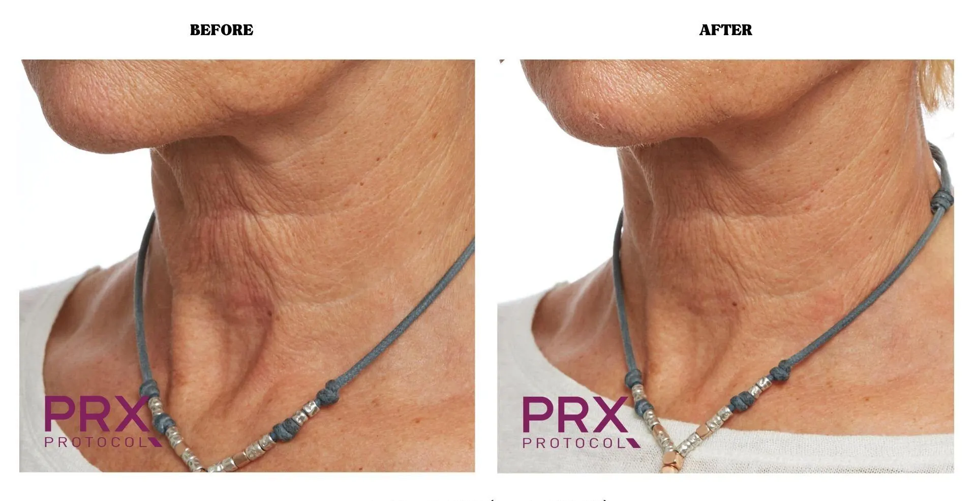 PRX - Before and After