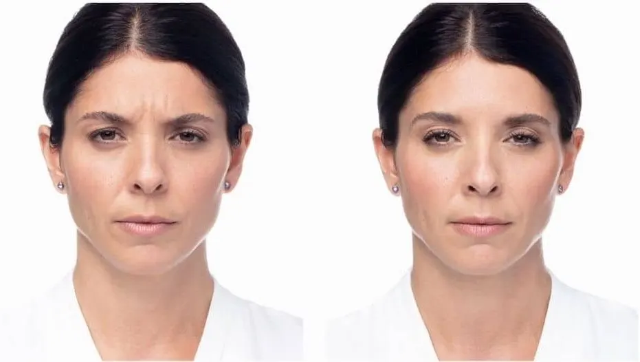 Dysport - Before and After