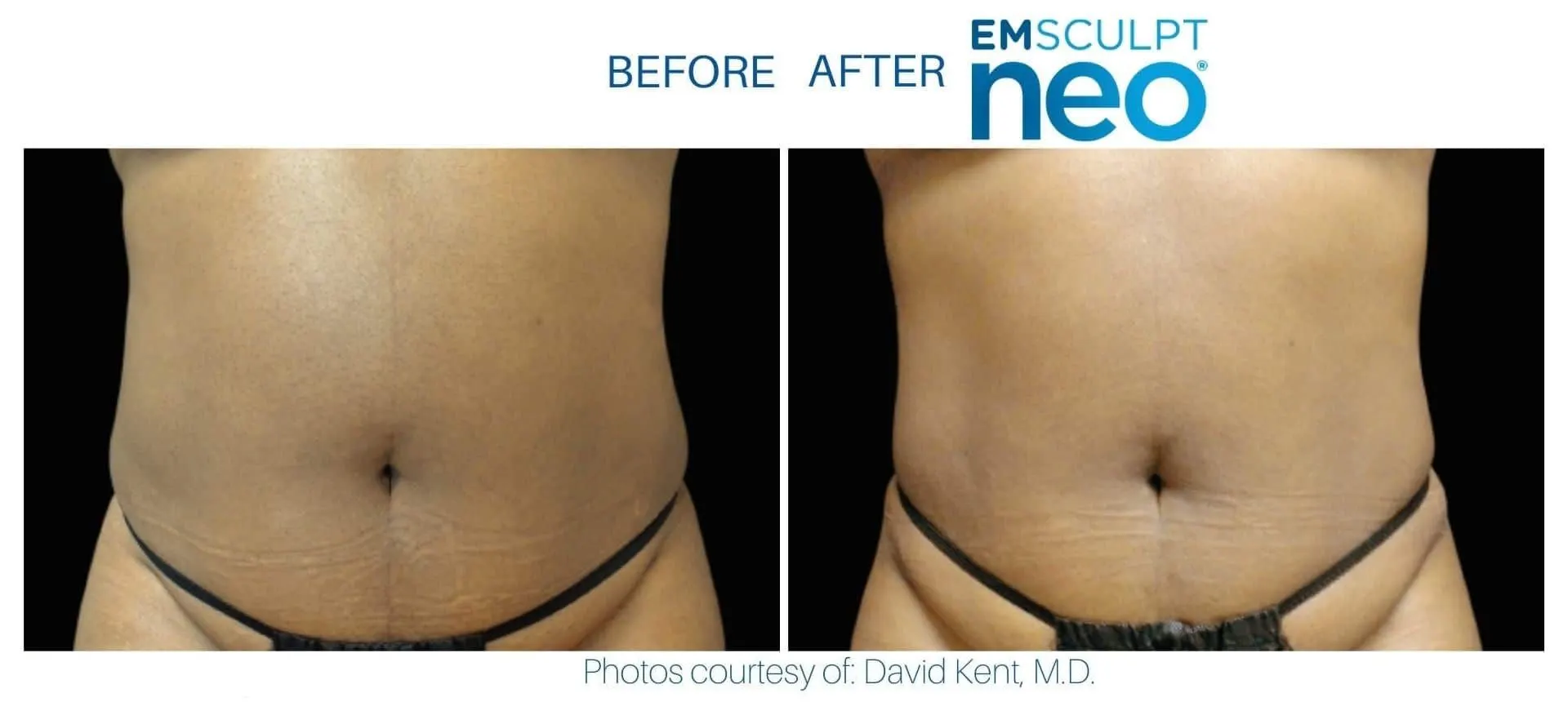 Emsculpt Neo - Before and After