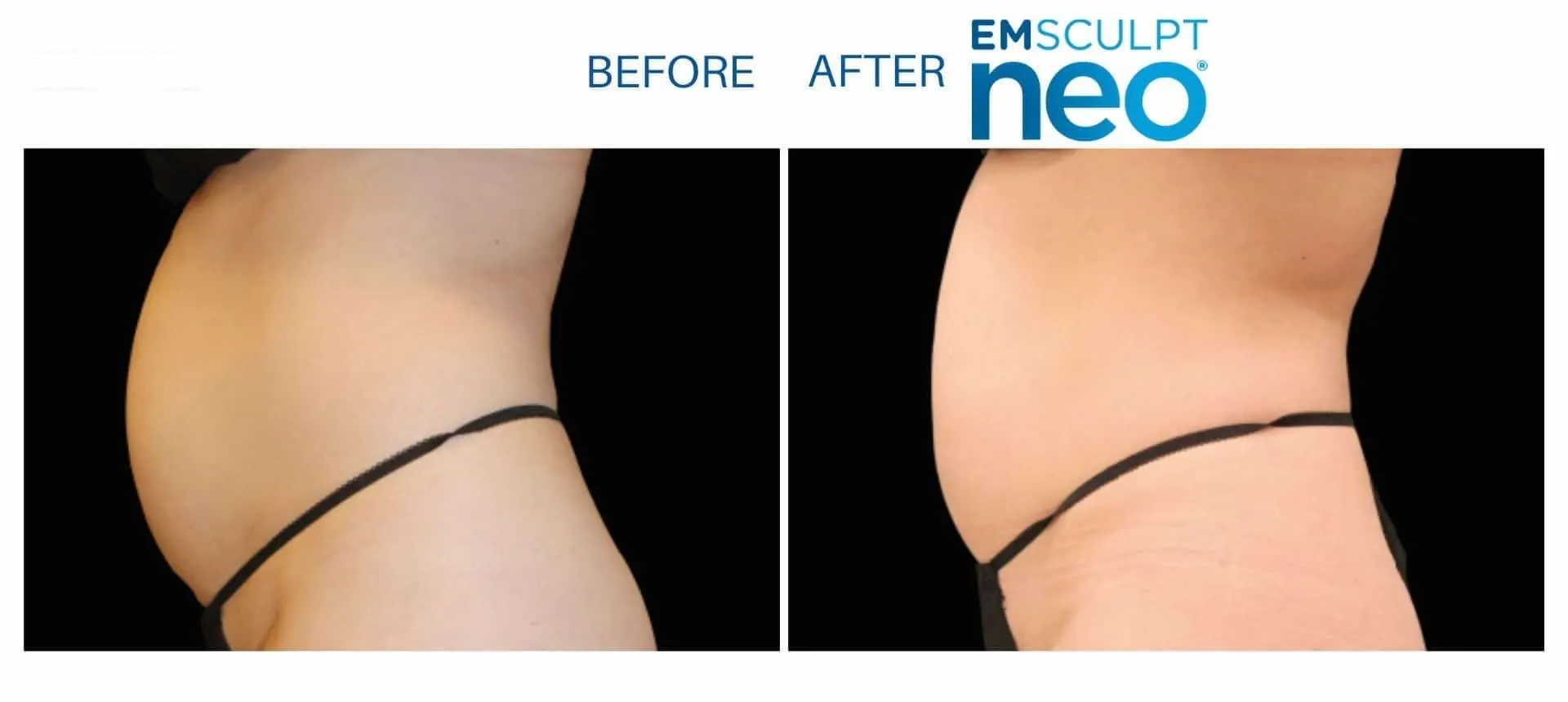Emsculpt Neo - Before and After