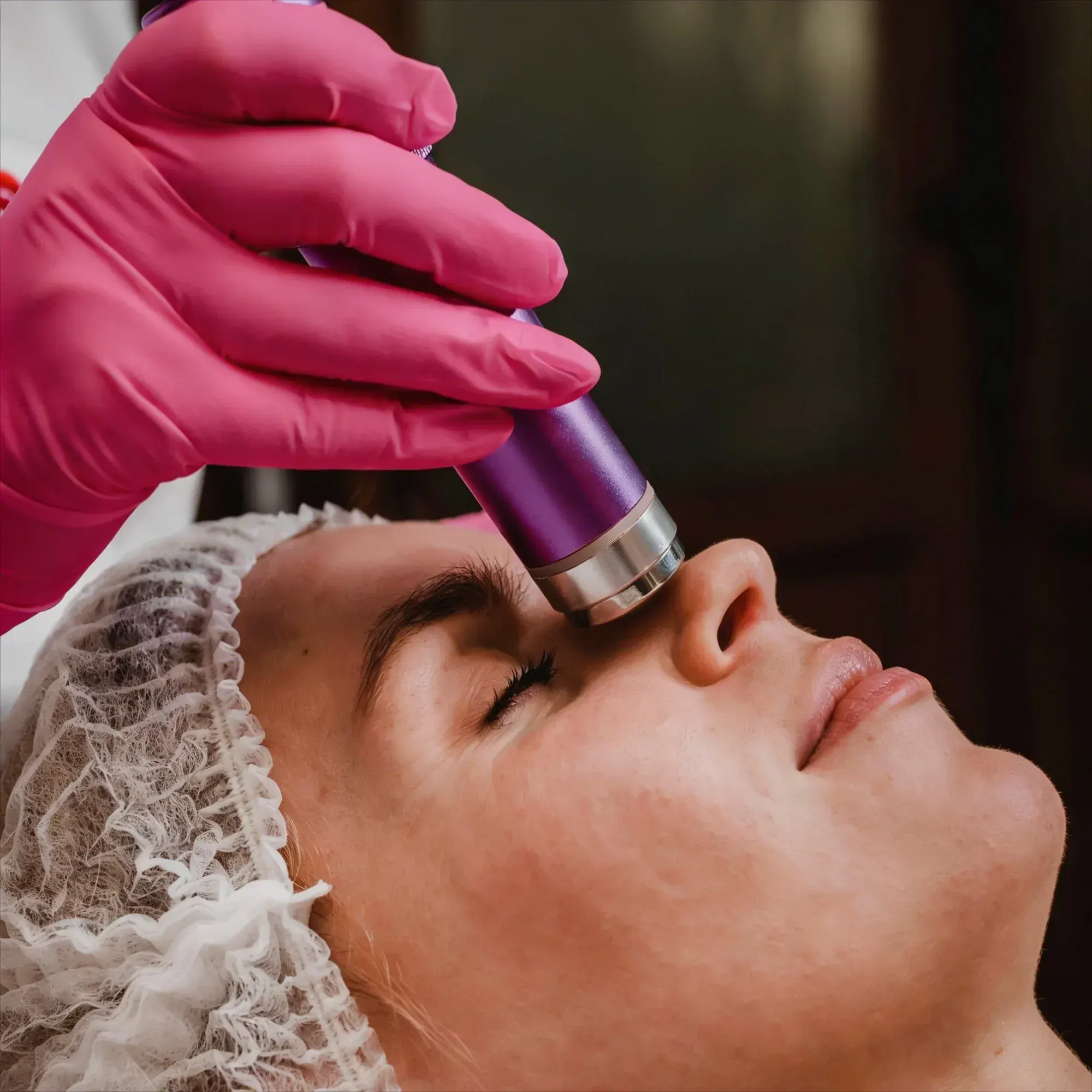 Benefits of RF Microneedling