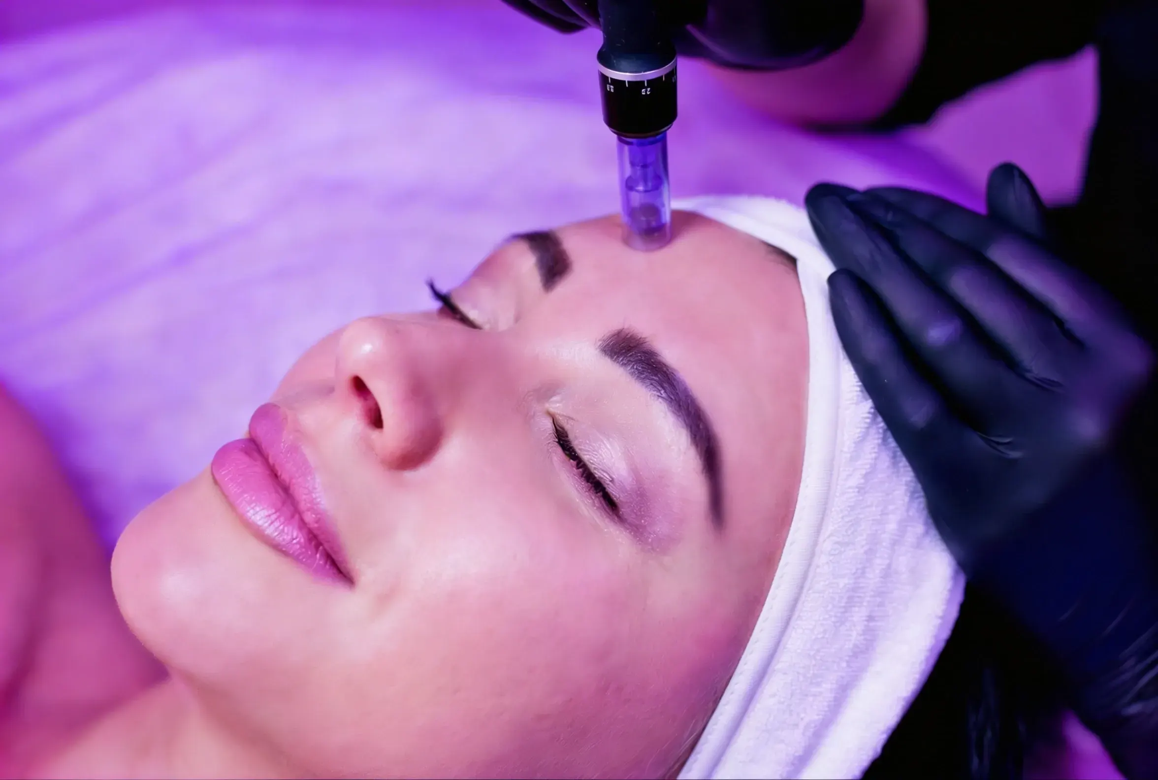 Microneedling treatment at RegalMed Clinic in Fort Myers, FL
