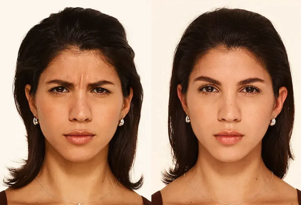 Botox  - Before and After
