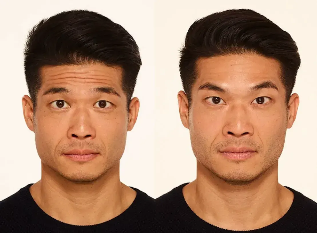 Botox  - Before and After